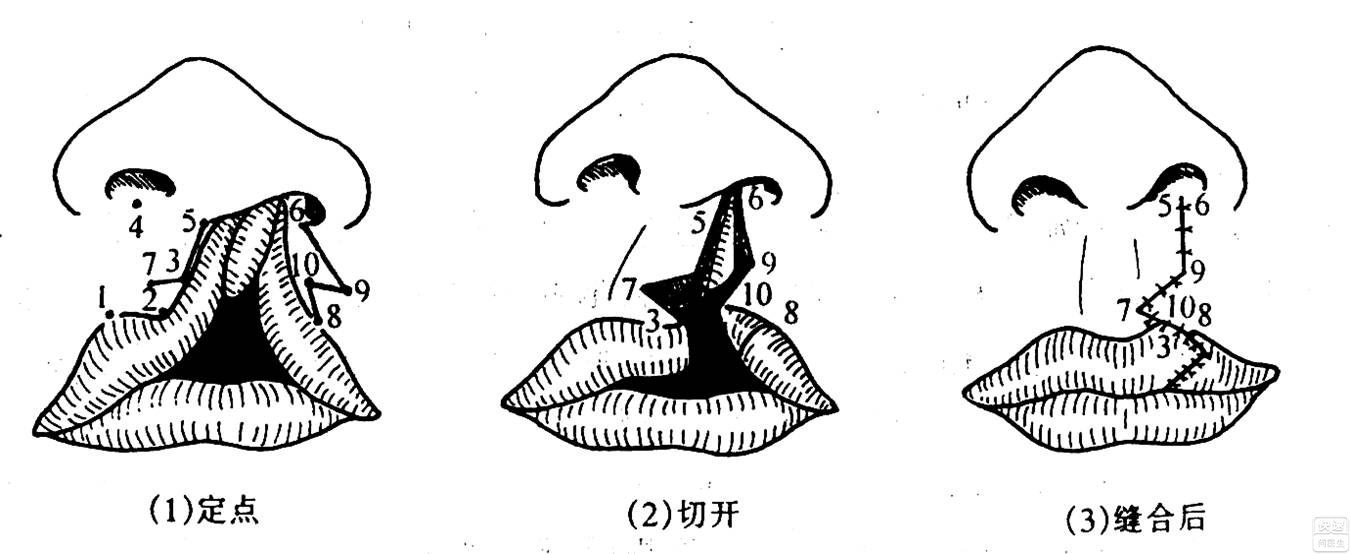 唇裂术后畸形修复术 唇裂修复术注意事项