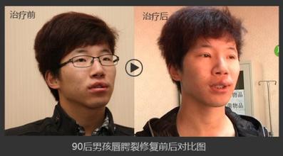 唇裂术后畸形修复术 唇裂修复术注意事项