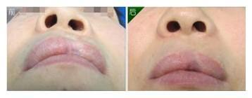 唇裂术后畸形修复术 唇裂修复术注意事项