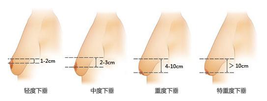 乳房松软下垂的原因