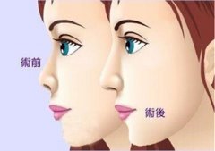 玻尿酸隆鼻果怎么样 玻尿酸隆鼻多少次可以永.久