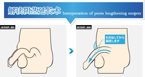 阴经延长手术是怎么样的