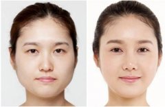 怎么判断割双眼皮手术后果 怎么判断割双眼皮手术后果