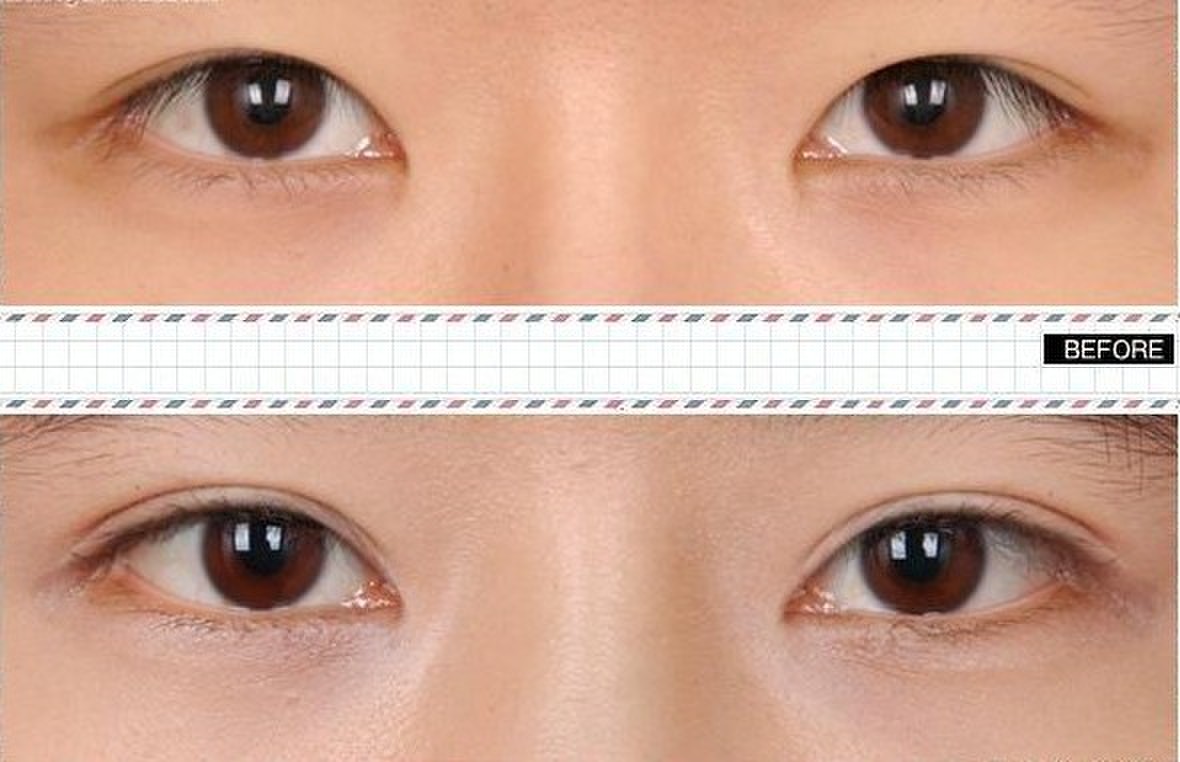 割双眼皮,后遗症