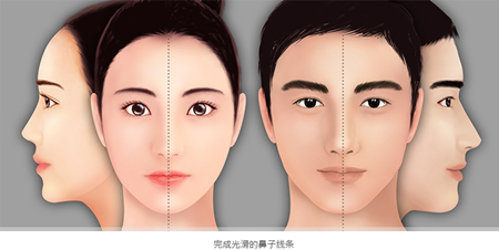 歪鼻矫正