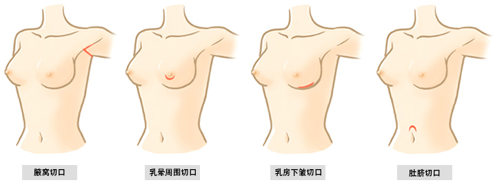 假体丰胸手术