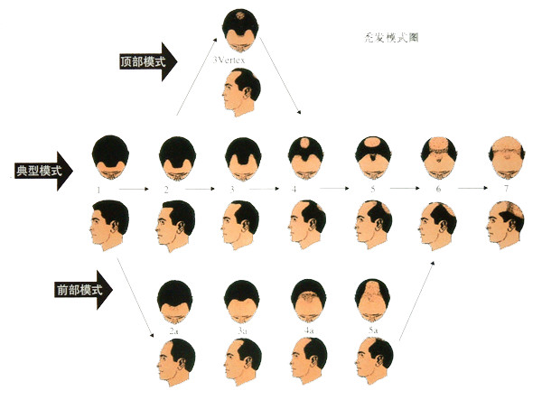 植发手术果