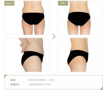 腰腹吸脂术后会不会反弹 腰腹吸脂术后会不会反弹