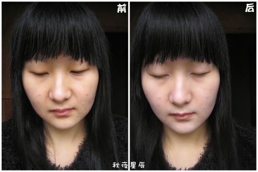 光子嫩肤的果怎么样 光子嫩肤果图