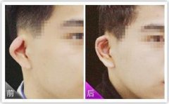 杯状耳怎么矫正 杯状耳矫正术的适应症