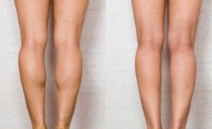 注射瘦脸注射瘦腿价格 注射瘦脸瘦腿多少钱