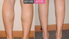 注射注射瘦脸瘦腿的果如何 注射瘦脸注射瘦腿能保持多久