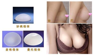 假体隆胸的优势有哪些