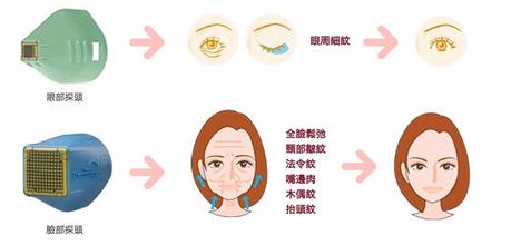 电波l皮除皱成好吗 电波l皮果图
