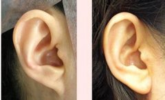 专家解析耳廓整形手术