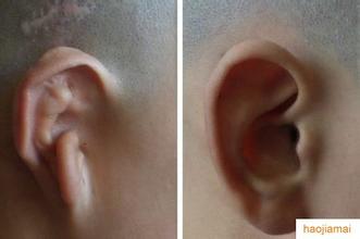 专家解析耳廓整形手术