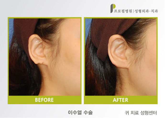 专家解析耳廓整形手术