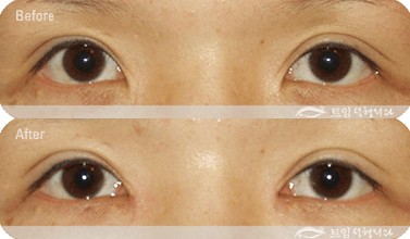 开内眼角有什么风险吗
