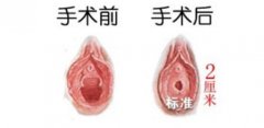 处女膜修复手术**高吗