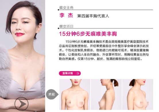 进口膨体,进口丰胸