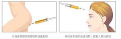 自体脂肪丰额头让额头更漂亮 自体脂肪丰额头让额头更漂亮