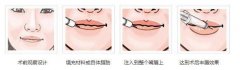 注射丰唇价格 注射丰唇价格