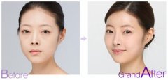 什么是smart鼻部整形术 鼻部整形术有什么优势 什么是smart鼻部整形术 鼻部整形术有什么优势