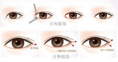 开眼角前后对比 大眼睛你也可以拥有