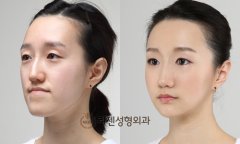 女人尖下颌角整形美丽新标准