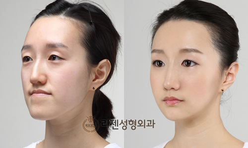 女人尖下颌角整形美丽新标准