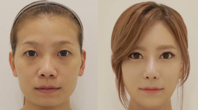 女人尖下颌角整形美丽新标准