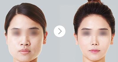 国产和进口注射瘦脸区别