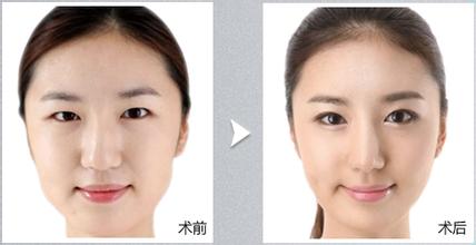 磨骨改脸型整形的弊端 磨骨改脸型风险性大吗