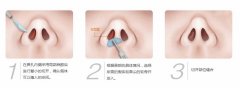 假体隆鼻是怎么做的 假体隆鼻鼻子以后会变形吗