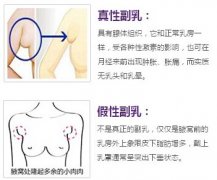 副乳是怎么形成的 副乳一定要切除吗