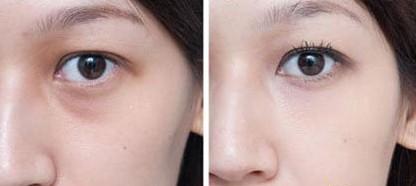 怎样除眼袋 激光溶脂去眼袋