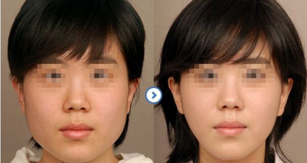 改变脸型的方法是什么?改脸型手术将会告诉您答案