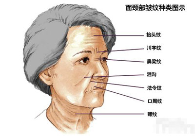 射频除皱