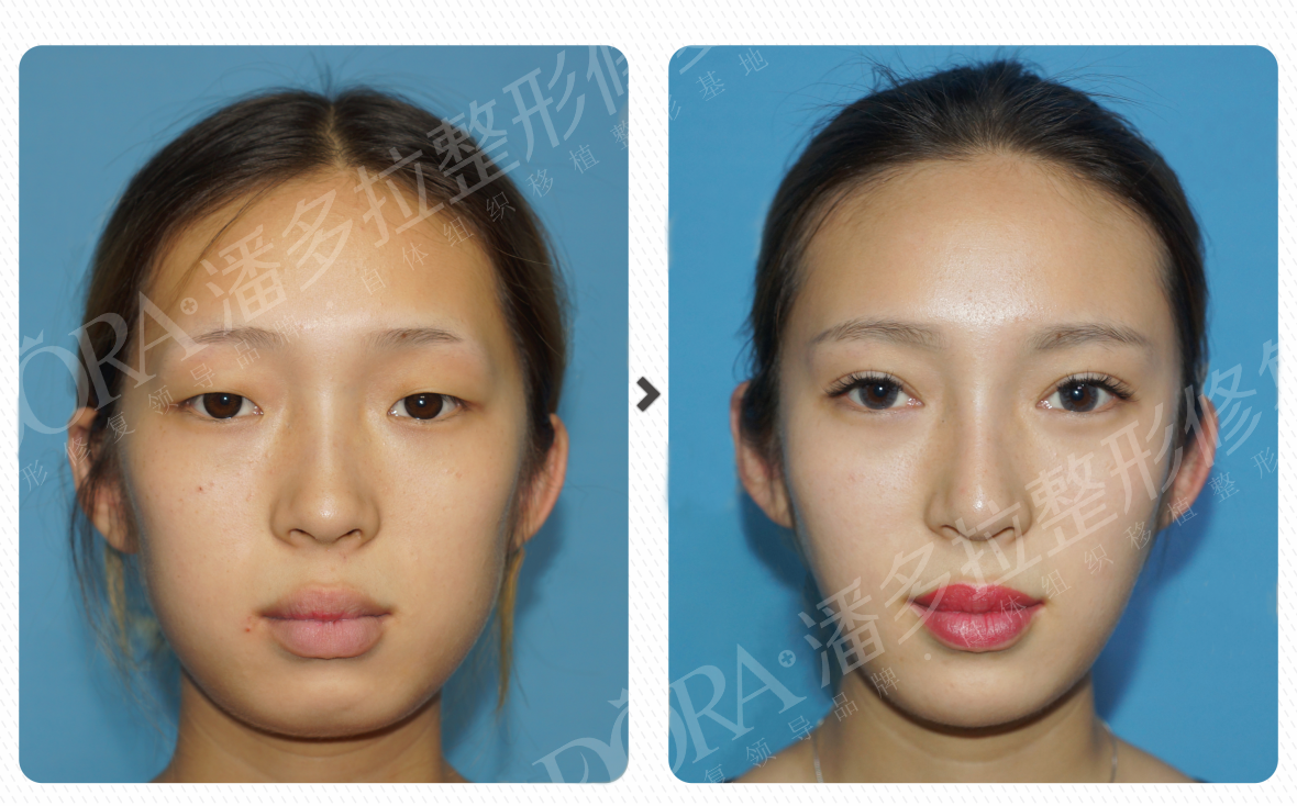 重庆潘多拉整形暑期特惠 冰点脱腋毛仅需88元