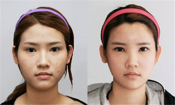 改脸型手术介绍