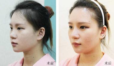 自体脂肪丰下巴术后注意事项