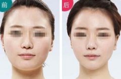 面部吸脂减肥手术价格 面部吸脂减肥手术价格