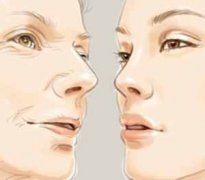 激光去除鱼尾纹的果怎么样