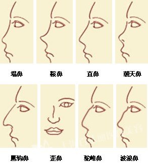 隆鼻假体取出