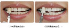 冷光美白和洗牙的区别