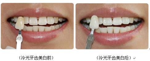 冷光美白和洗牙的区别