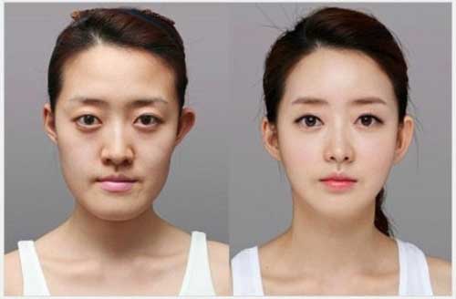 脸部整形前后对比图一,脸部整形需要多少钱受优惠折扣影响目前,优惠