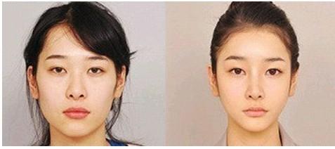 打B****前后对比图 B****打几次能定型