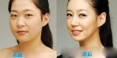 韩国v-line瓜子脸整形手术