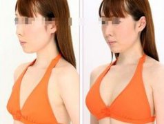 韩式假体丰胸的优点 韩式假体丰胸有什么优势